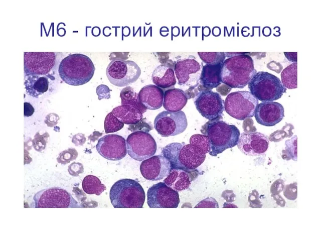 М6 - гострий еритромієлоз