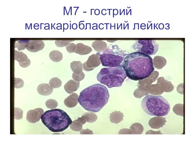 М7 - гострий мегакаріобластний лейкоз