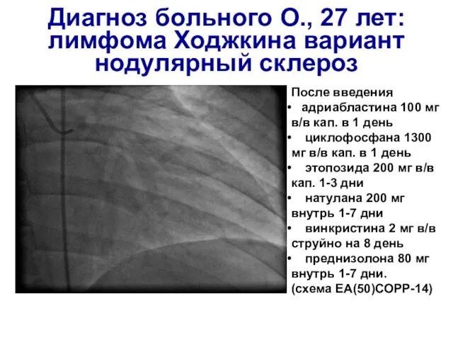 Диагноз больного О., 27 лет: лимфома Ходжкина вариант нодулярный склероз