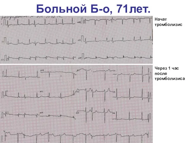 Больной Б-о, 71лет. Через 1 час после тромболизиса Начат тромболизис