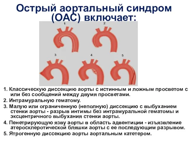 Острый аортальный синдром (ОАС) включает: 1. Классическую диссекцию аорты с