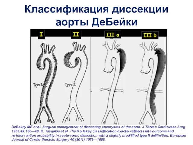 Классификация диссекции аорты ДеБейки DeBakey ME et al. Surgical management