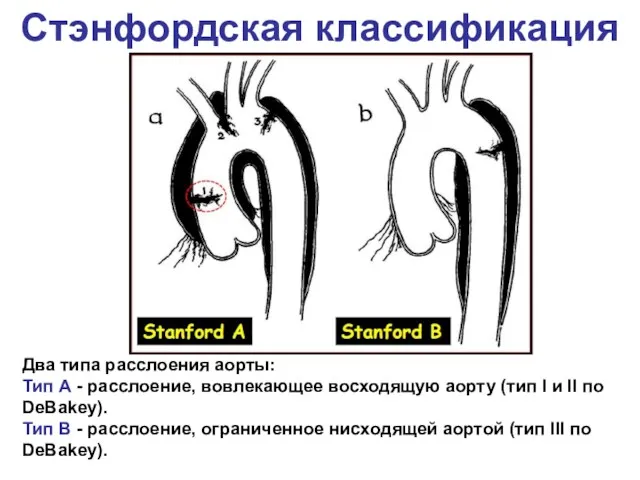 Стэнфордская классификация Два типа расслоения аорты: Тип А - расслоение, вовлекающее восходящую аорту