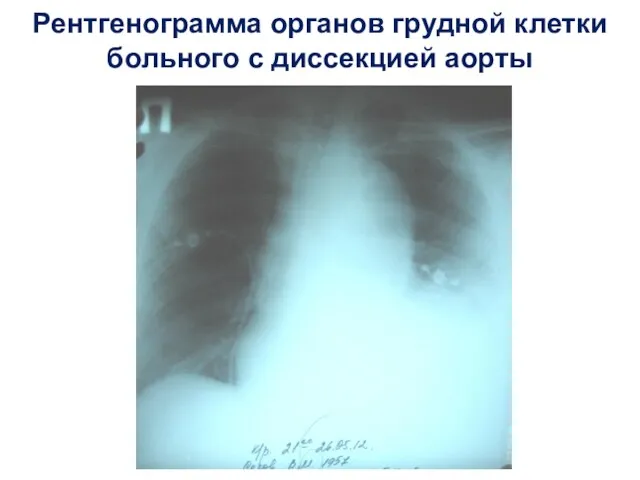Рентгенограмма органов грудной клетки больного с диссекцией аорты