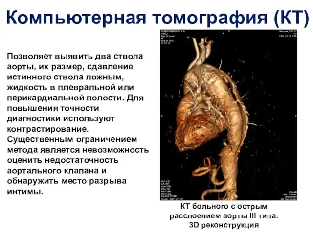 Компьютерная томография (КТ) КТ больного с острым расслоением аорты III типа. 3D реконструкция