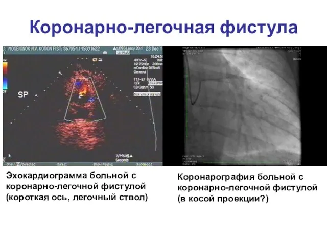 Коронарно-легочная фистула Коронарография больной с коронарно-легочной фистулой (в косой проекции?) Эхокардиограмма больной с