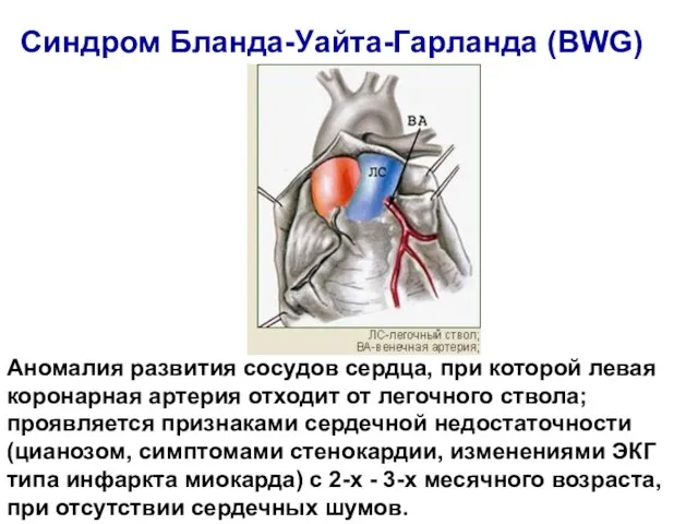 Аномалия развития сосудов сердца, при которой левая коронарная артерия отходит от легочного ствола;
