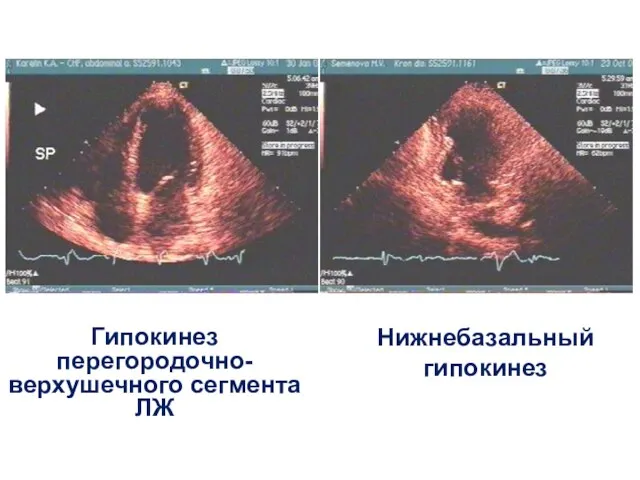 Гипокинез перегородочно-верхушечного сегмента ЛЖ Нижнебазальный гипокинез