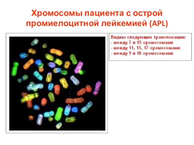 Хромосомы пациента с острой промиелоцитной лейкемией (APL)