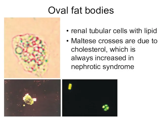 Oval fat bodies renal tubular cells with lipid Maltese crosses