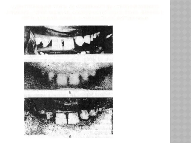 ИДЕНТИФИКАЦИЯ ТРУПА ПО ОСОБЕННОСТЯМ СТРОЕНИЯ ЗУБНОГО АППАРАТА: СОПОСТАВЛЕНИЕ ОСОБЕННОСТЕЙ ЗУБОВ