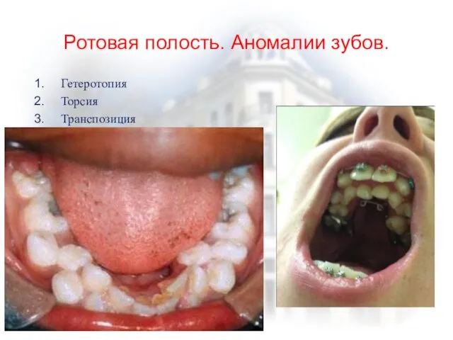 Ротовая полость. Аномалии зубов. Гетеротопия Торсия Транспозиция