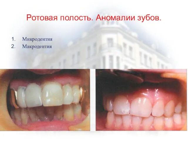 Ротовая полость. Аномалии зубов. Микродентия Макродентия