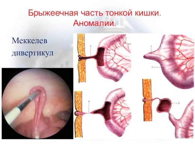 Брыжеечная часть тонкой кишки. Аномалии. Меккелев дивертикул