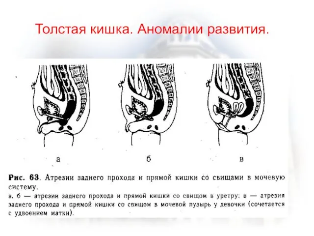 Толстая кишка. Аномалии развития.