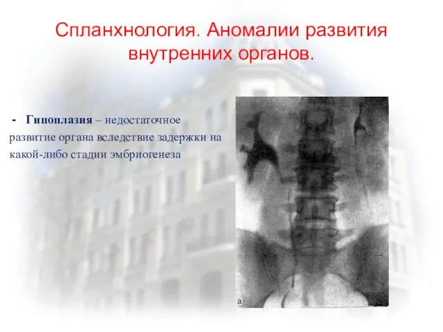 Спланхнология. Аномалии развития внутренних органов. Гипоплазия – недостаточное развитие органа вследствие задержки на какой-либо стадии эмбриогенеза