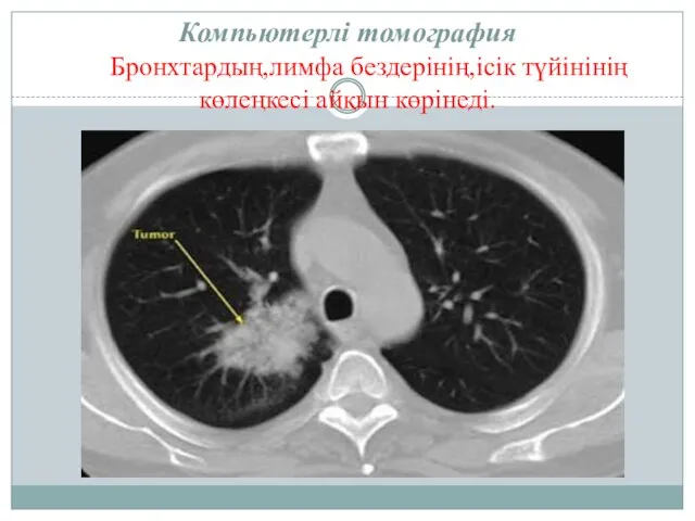 Компьютерлі томография Бронхтардың,лимфа бездерінің,ісік түйінінің көлеңкесі айқын көрінеді.