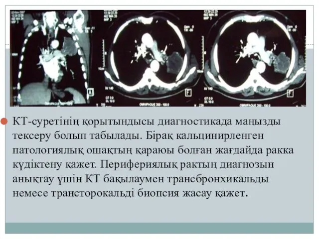 КТ-суретінің қорытындысы диагностикада маңызды тексеру болып табылады. Бірақ кальцинирленген патологиялық