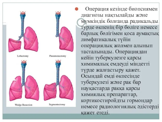 Операция кезінде биопсиямен диагнозы нақтылайды және мүмкіндік болғанда радикальды турде