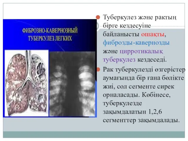 Туберкулез және рактың бірге кездесуіне байланысты ошақты, фиброзды-кавернозды және цирротикалық