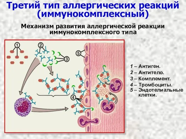 Третий тип аллергических реакций (иммунокомплексный) Механизм развития аллергической реакции иммунокомплексного типа 1 –