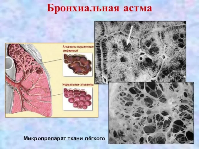 Бронхиальная астма Микропрепарат ткани лёгкого