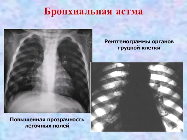 Бронхиальная астма Рентгенограммы органов грудной клетки Повышенная прозрачность лёгочных полей