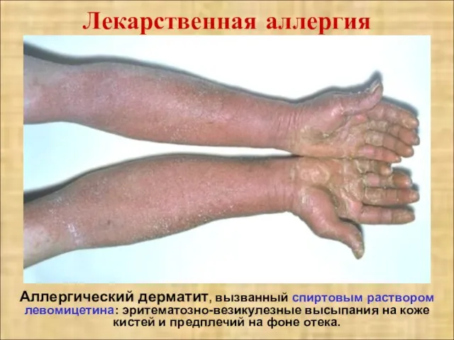 Лекарственная аллергия Аллергический дерматит, вызванный спиртовым раствором левомицетина: эритематозно-везикулезные высыпания на коже кистей
