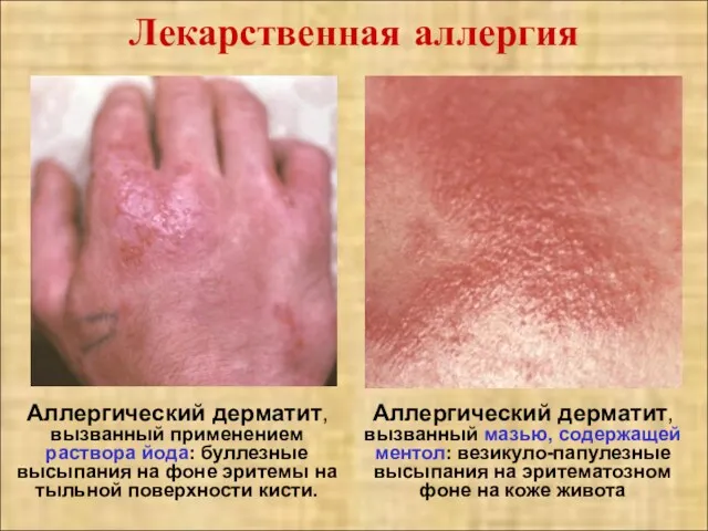 Лекарственная аллергия Аллергический дерматит, вызванный применением раствора йода: буллезные высыпания на фоне эритемы