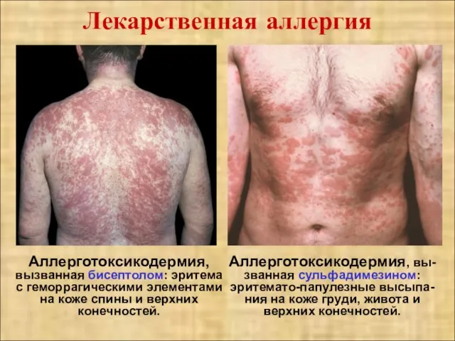 Лекарственная аллергия Аллерготоксикодермия, вызванная бисептолом: эритема с геморрагическими элементами на коже спины и