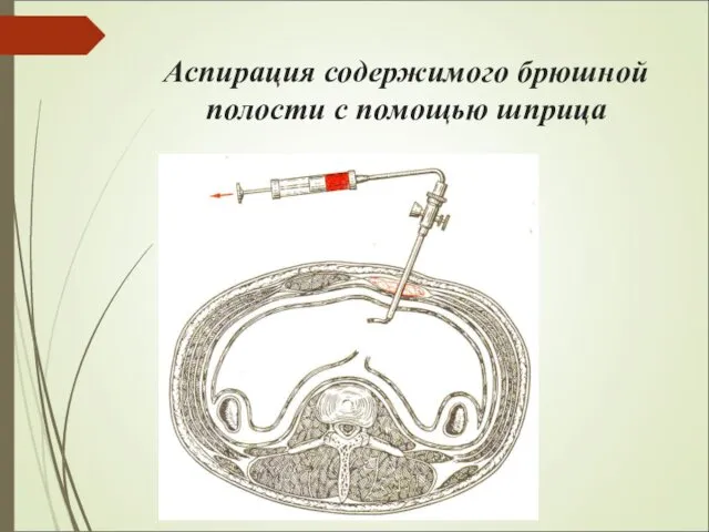 Аспирация содержимого брюшной полости с помощью шприца