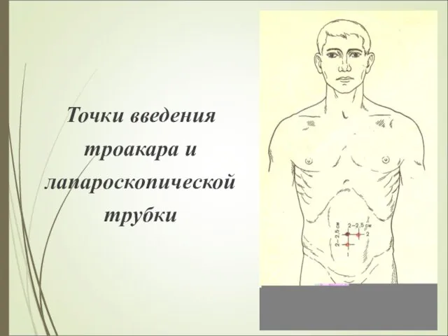 Точки введения троакара и лапароскопической трубки