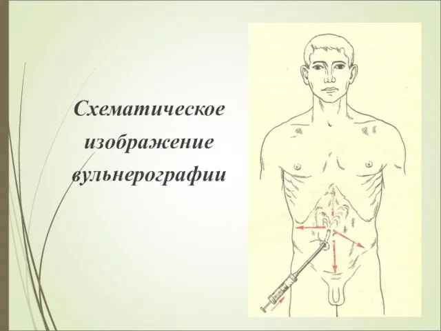 Схематическое изображение вульнерографии