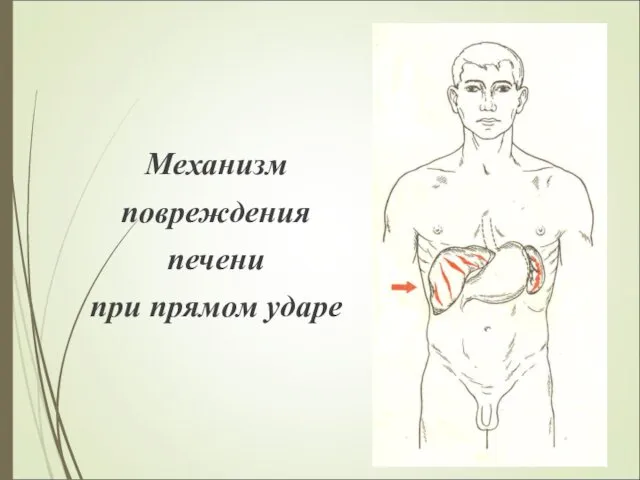 Механизм повреждения печени при прямом ударе