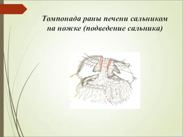 Томпонада раны печени сальником на ножке (подведение сальника)