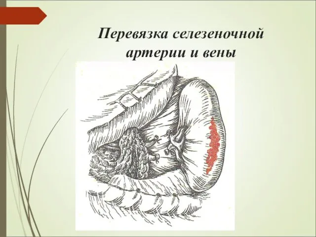 Перевязка селезеночной артерии и вены