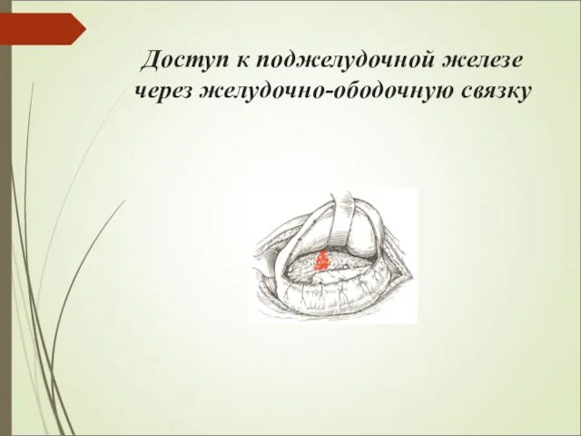 Доступ к поджелудочной железе через желудочно-ободочную связку