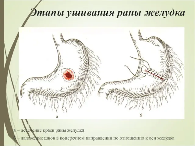 Этапы ушивания раны желудка а – иссечение краев раны желудка