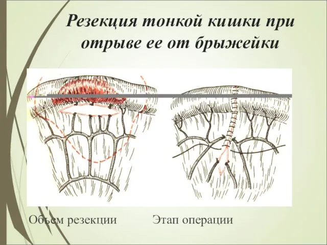 Резекция тонкой кишки при отрыве ее от брыжейки Объем резекции Этап операции
