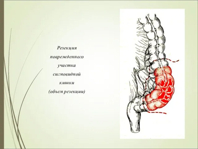 Резекция поврежденного участка сигмовидной кишки (объем резекции)