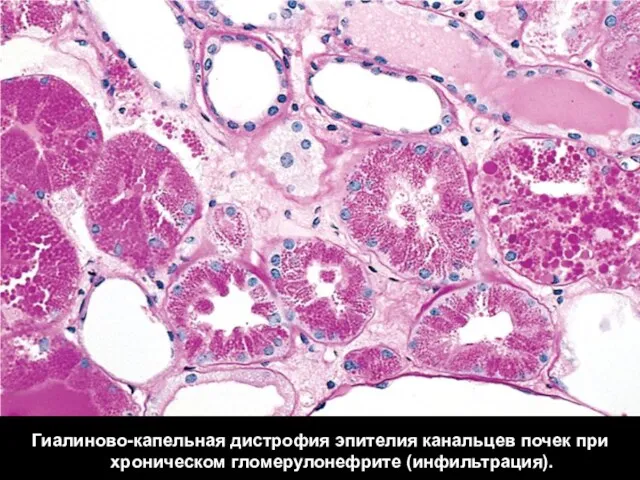 Гиалиново-капельная дистрофия эпителия канальцев почек при хроническом гломерулонефрите (инфильтрация).