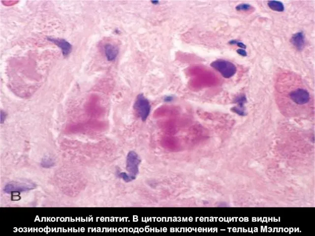 Алкогольный гепатит. В цитоплазме гепатоцитов видны эозинофильные гиалиноподобные включения – тельца Мэллори.