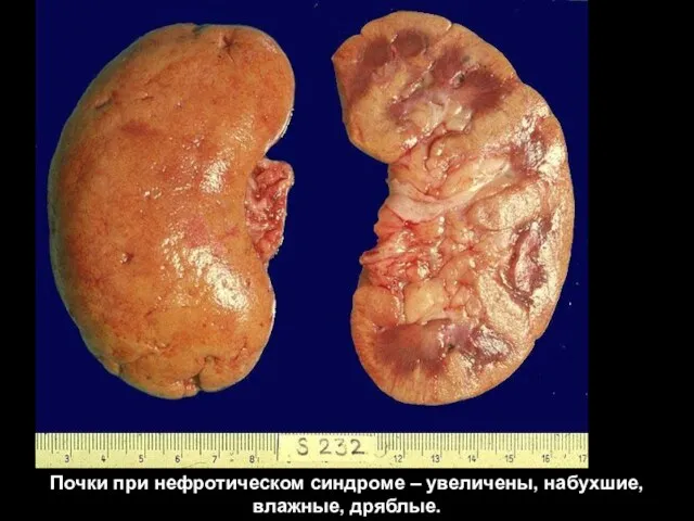 Острая почечная недостаточность Почки при нефротическом синдроме – увеличены, набухшие, влажные, дряблые.