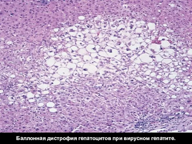 Баллонная дистрофия гепатоцитов при вирусном гепатите.