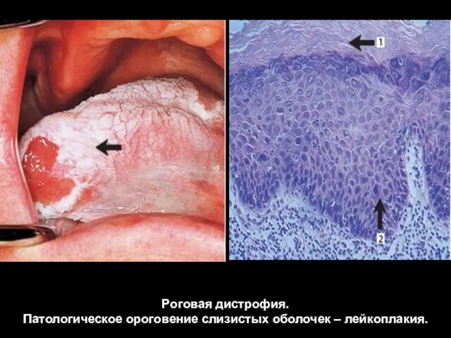 Роговая дистрофия. Патологическое ороговение слизистых оболочек – лейкоплакия.