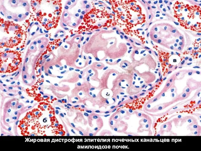 Жировая дистрофия эпителия почечных канальцев при амилоидозе почек. А Б В