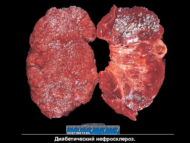 Диабетический нефросклероз.