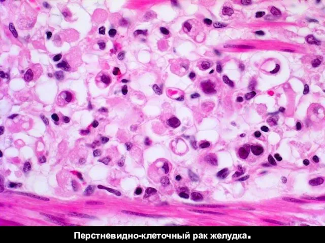 Перстневидно-клеточный рак желудка.