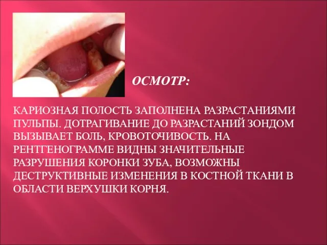 ОСМОТР: КАРИОЗНАЯ ПОЛОСТЬ ЗАПОЛНЕНА РАЗРАСТАНИЯМИ ПУЛЬПЫ. ДОТРАГИВАНИЕ ДО РАЗРАСТАНИЙ ЗОНДОМ