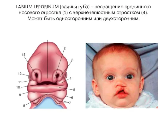 LABIUM LEPORINUM (заячья губа) – несращение срединного носового отростка (1) с верхнечелюстным отростком